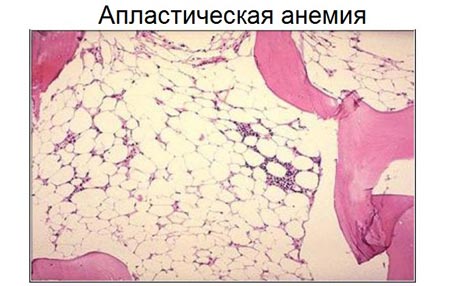 Состояние крови при малокровии