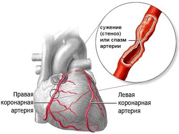 Правая и левая коронарные артерии