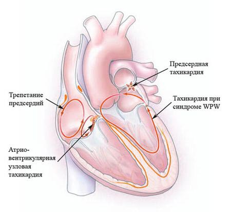 Суправентрикулярная тахикардия