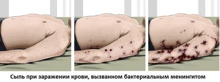 Сыпь при бактериальном менингите