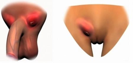 Паховый лимфаденит