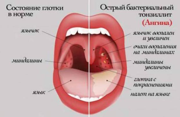 Острый бактериальный тонзиллит 
