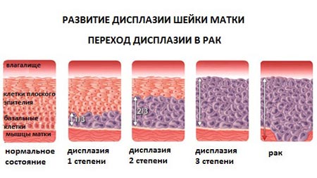 Развитие дисплазии шейки матки