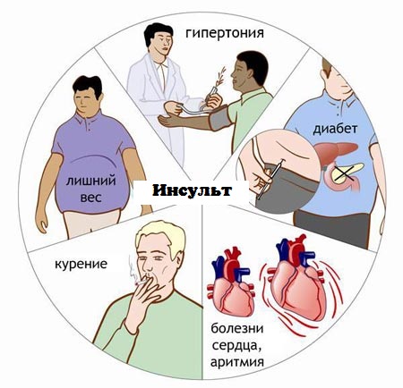 Факторы, которые провоцируют инсульт