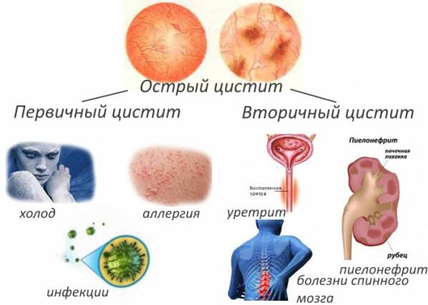 Острый цистит 