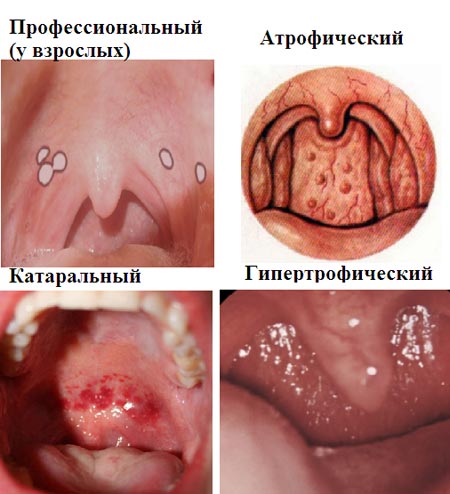 Виды ларингита 