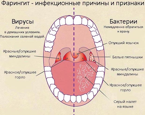 Причины и признаки фарингита 