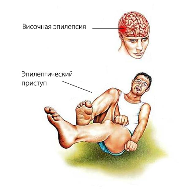 Височная эпилепсия