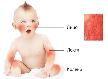 Чесотка у детей