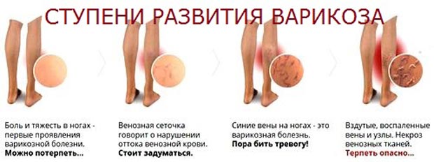 Стадии варикоза