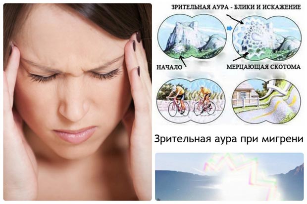 Зрительная аура при мигрени