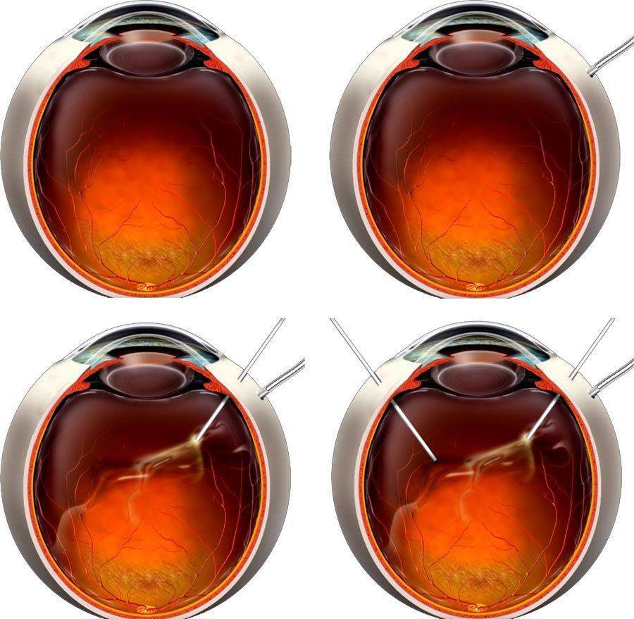 Как проходит витрэктомия Витрэктомия: алгоритм операции