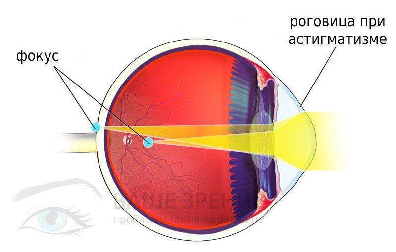 Схема глаза с астигматизмом Строение глаза при астигматизме