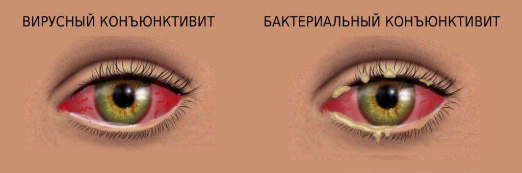 Разновидности конъюнктивита Вирусный и бактериальный конъюнктивит