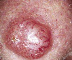 Что такое базалиома Как выглядит базалиома