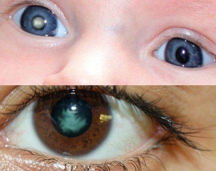 Повреждение хрусталика Начальная катаракта