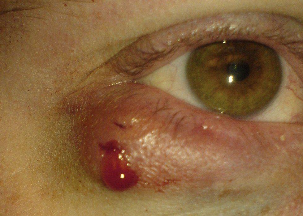 Одна из причин чесания глаза Халязион