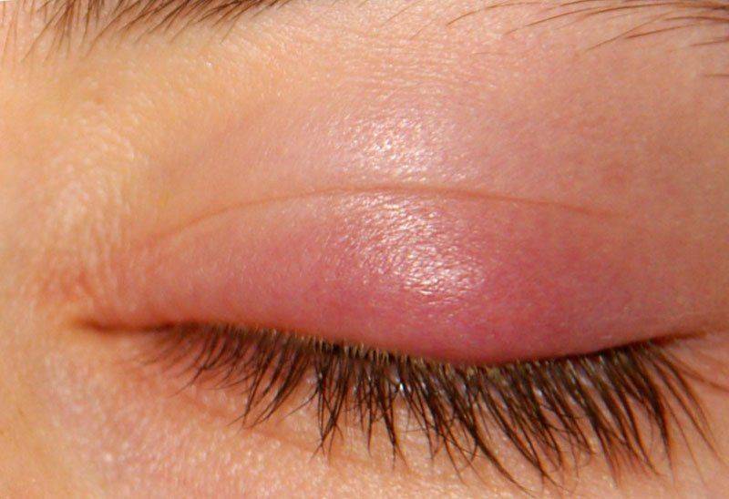 Как проявляется халязион Признаки халязиона