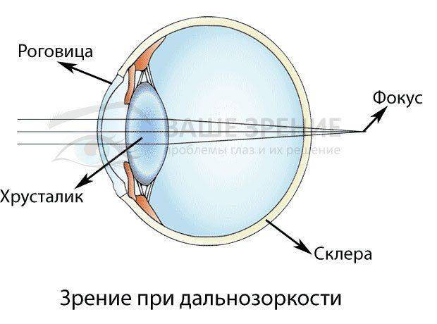 Как выглядит дальнозоркий глаз Глаз с дальнозоркостью