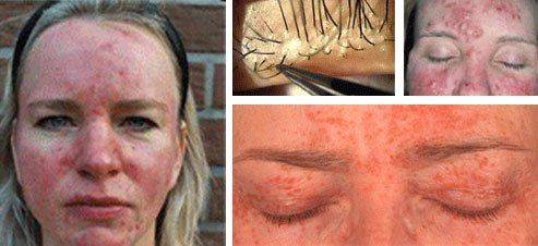 Признаки демодекоза Демодекоз на лице и глазах