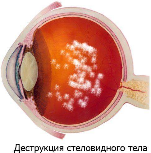 Дефект в глазу Что такое деструкция стекловидного тела