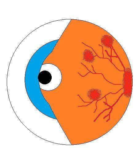 Схема диабетического вида Диабетический вид