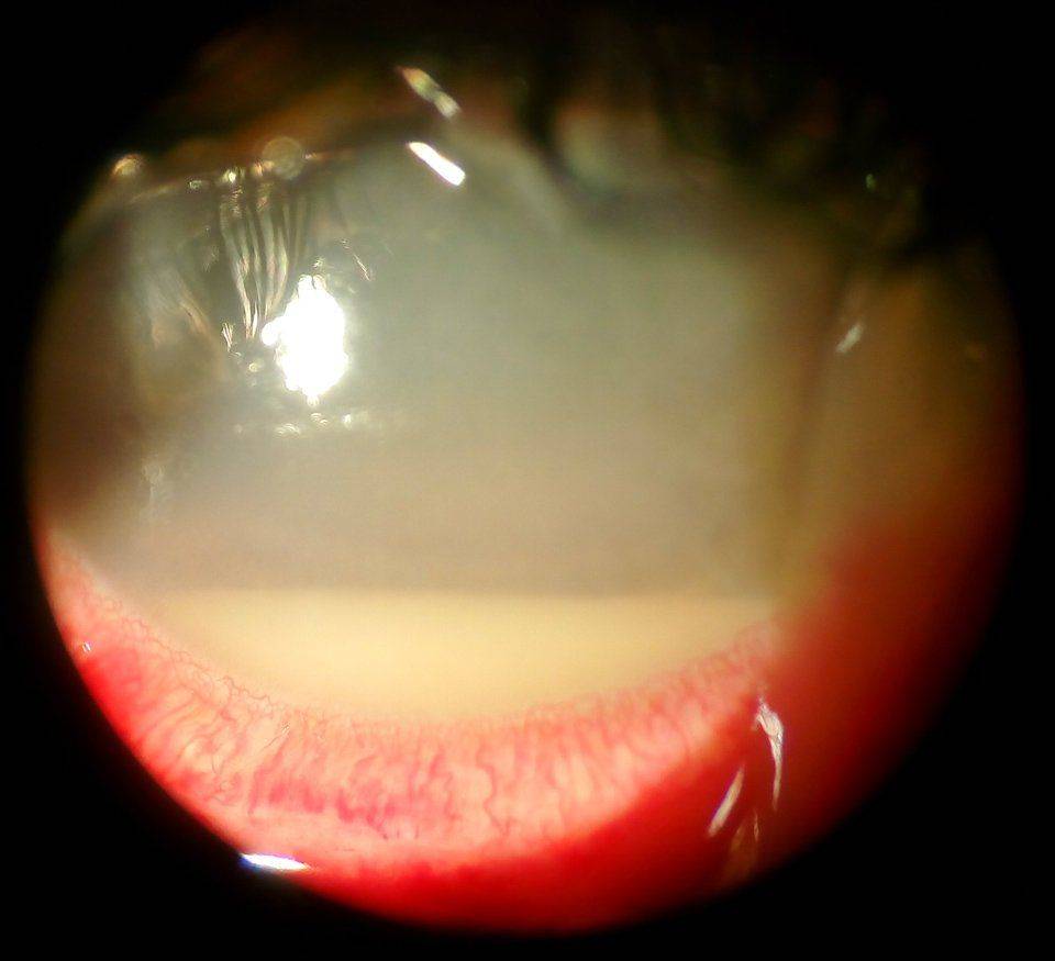 Гнойное поражение глаза Эндофтальмит