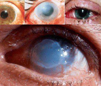 Что такое ожог роговицы Как выглядит ожог роговицы