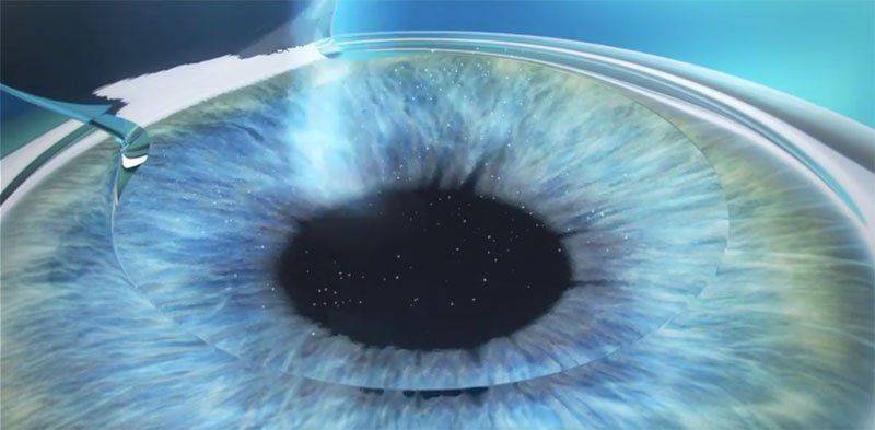 Что такое фемто ласик Как проводят фемто ласик