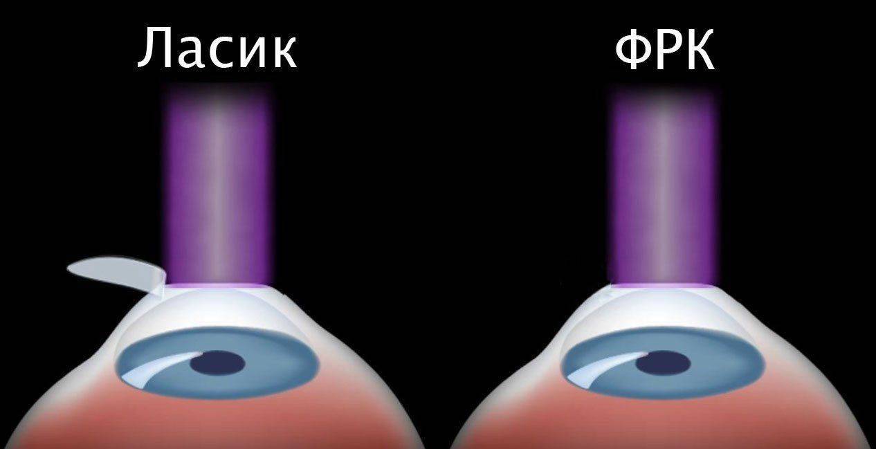 Два вида лазерных операций Отличия Ласик и ФРК