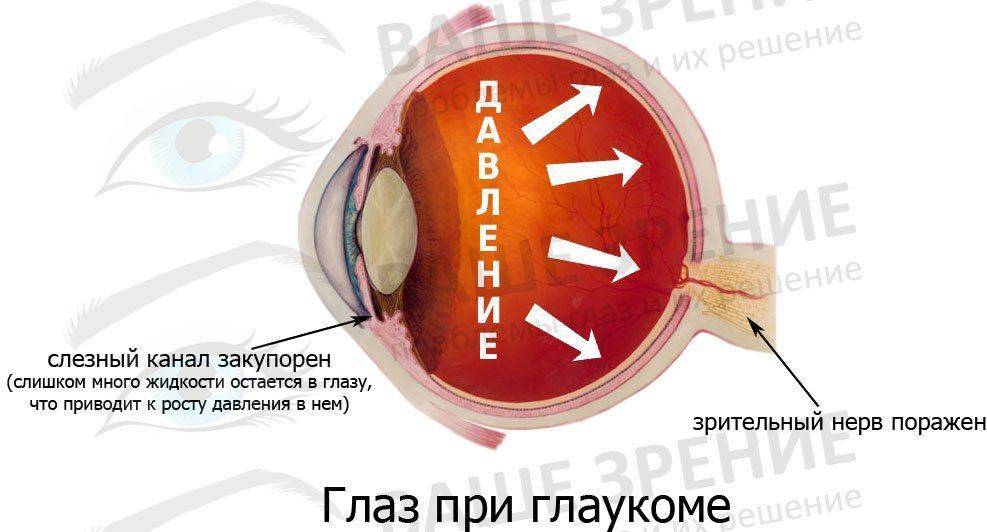 Что такое глаукома Глаз при глаукоме
