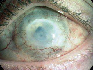 Сильное поражение Химический ожог глаза