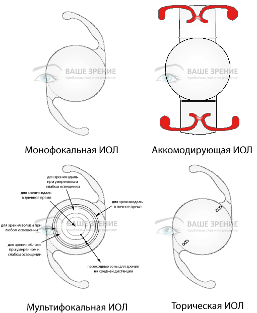 Виды искусственных хрусталиков Все виды ИОЛ