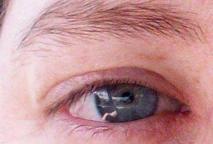 Воспаленный глаз Глаз с покраснением