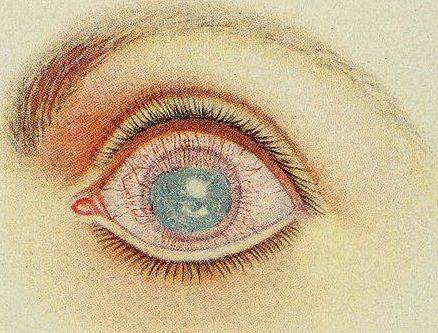 Помутнение хрусталика Симптомы катаракты