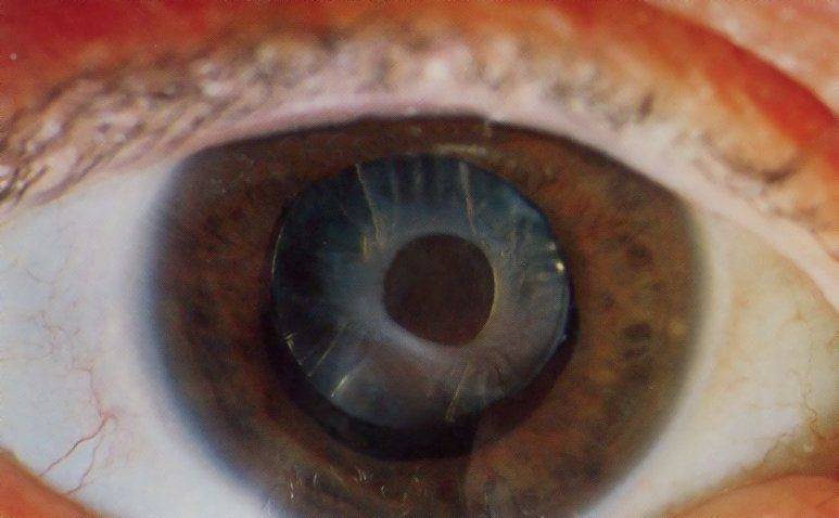 Поражение хрусталика Заднекапсулярная катаракта