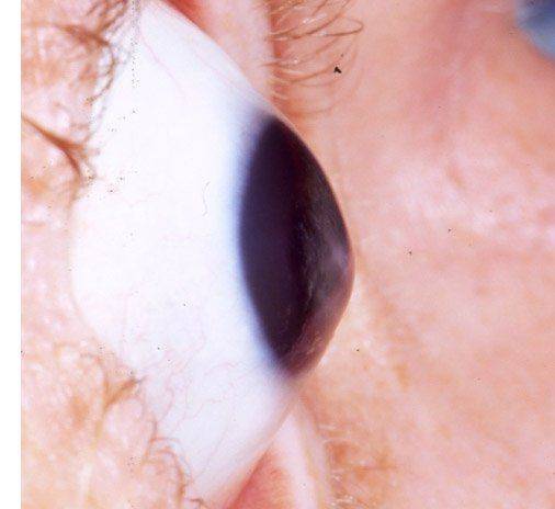 Измененная форма роговицы Кератоконус