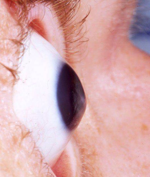 Как выглядит кератоконус Кератоконус