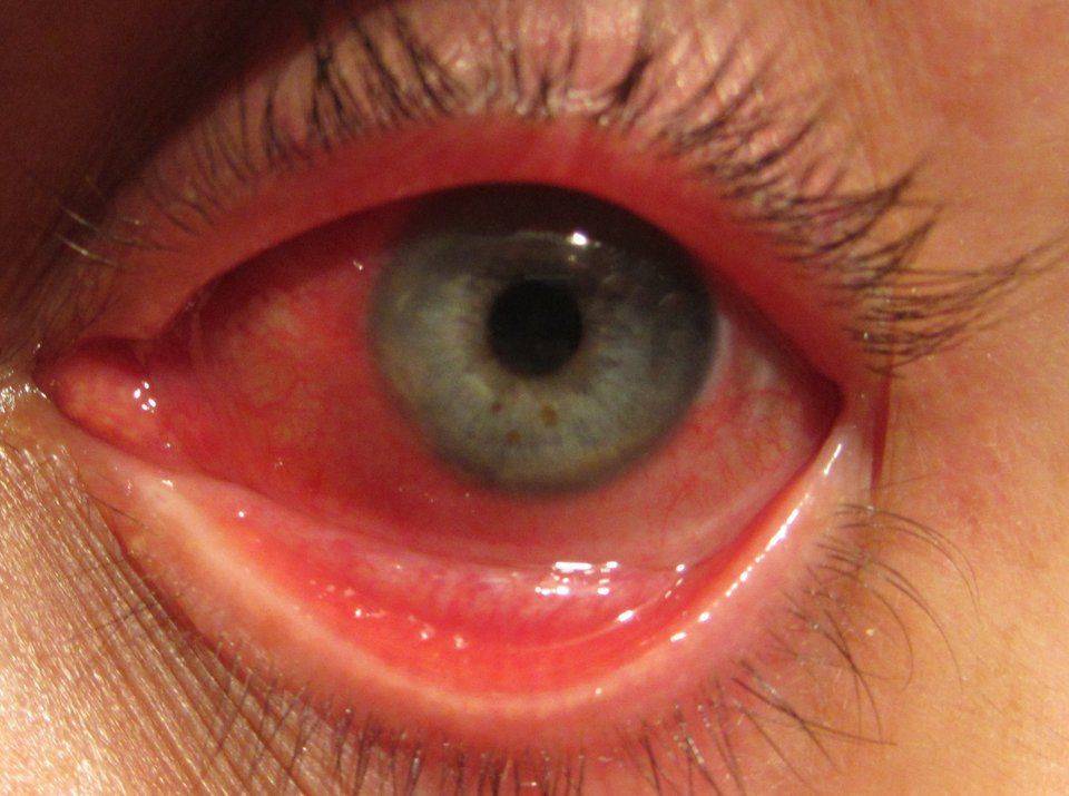 Воспалительный процесс Конъюнктивит