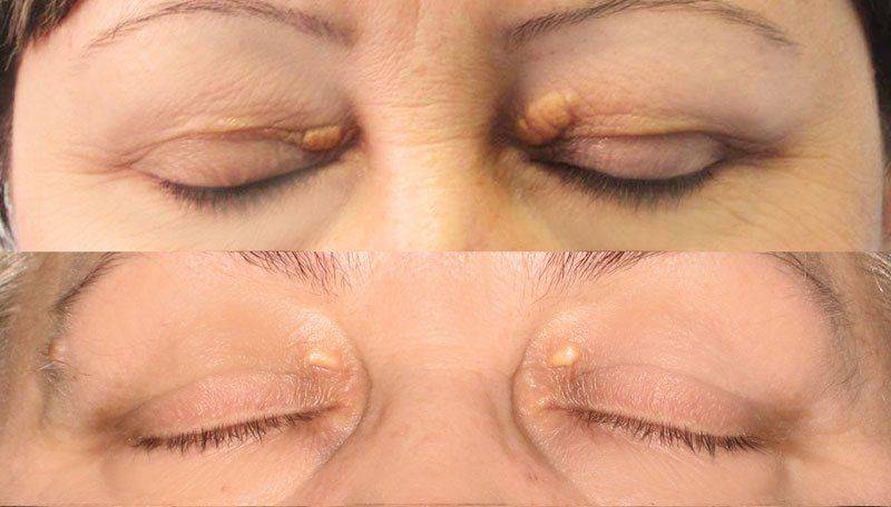 Признаки ксантелазмы Как выглядит ксантелазма