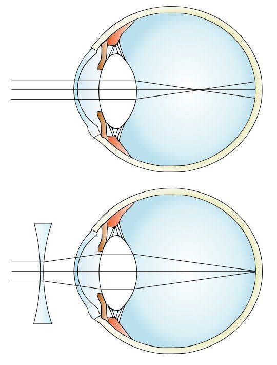 Миопия и очки Коррекция с помощью линзы