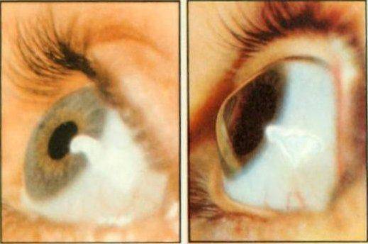 Два вида глаза Нормальный глаз и с кератоконусом