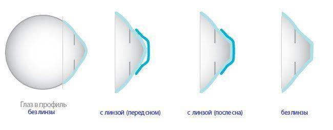 Механизм ортокератологии Как действует ортокератологический метод