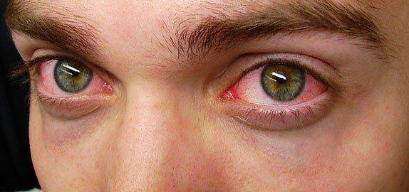 У мужчины устали глаза Покрасневшие и уставшие глаза