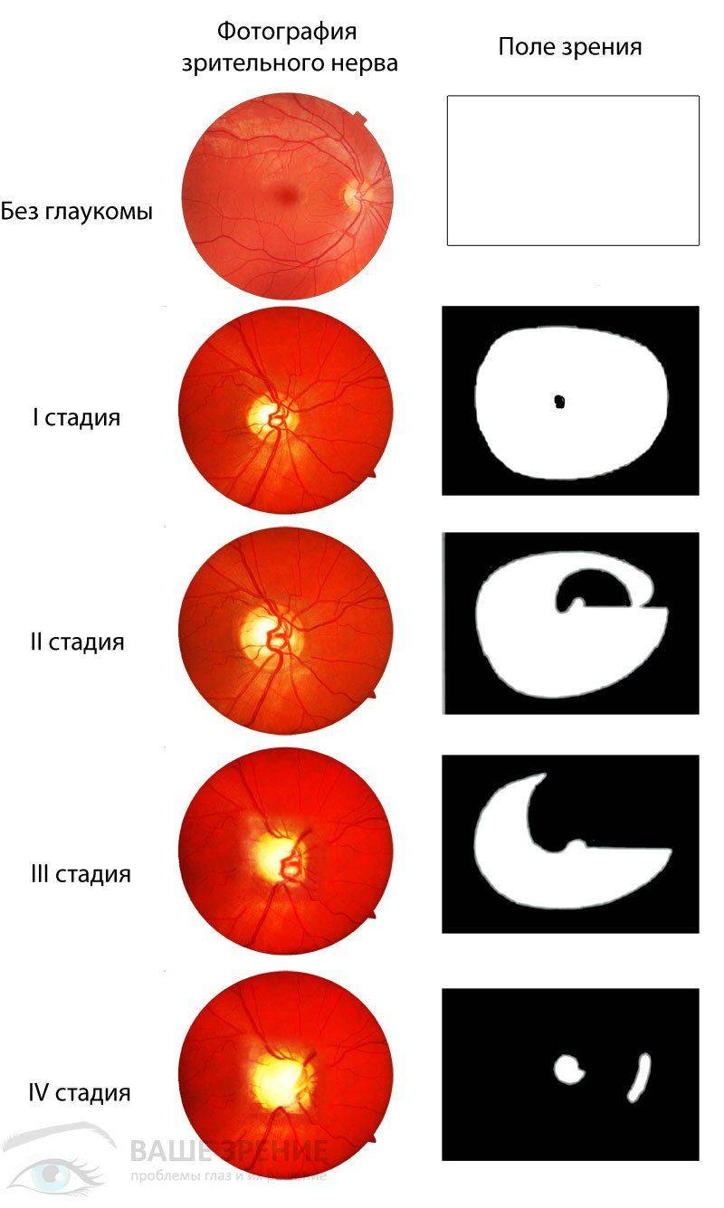 Четыре стадии Все стадии глаукомы