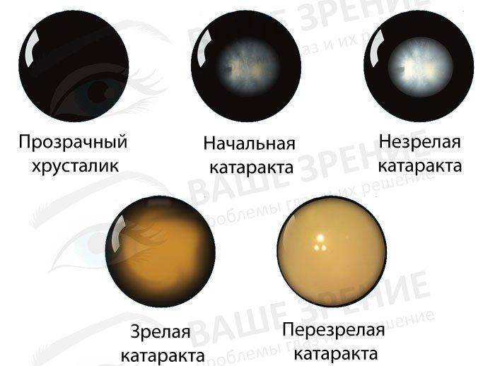 Какой бывает катаракта Все стадии катаракты
