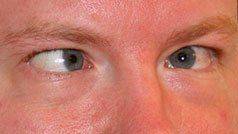 Мужчина с косоглазием Как выглядит косоглазие