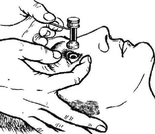 Тонометр Маклакова Как проводят тонометрию по Маклакову