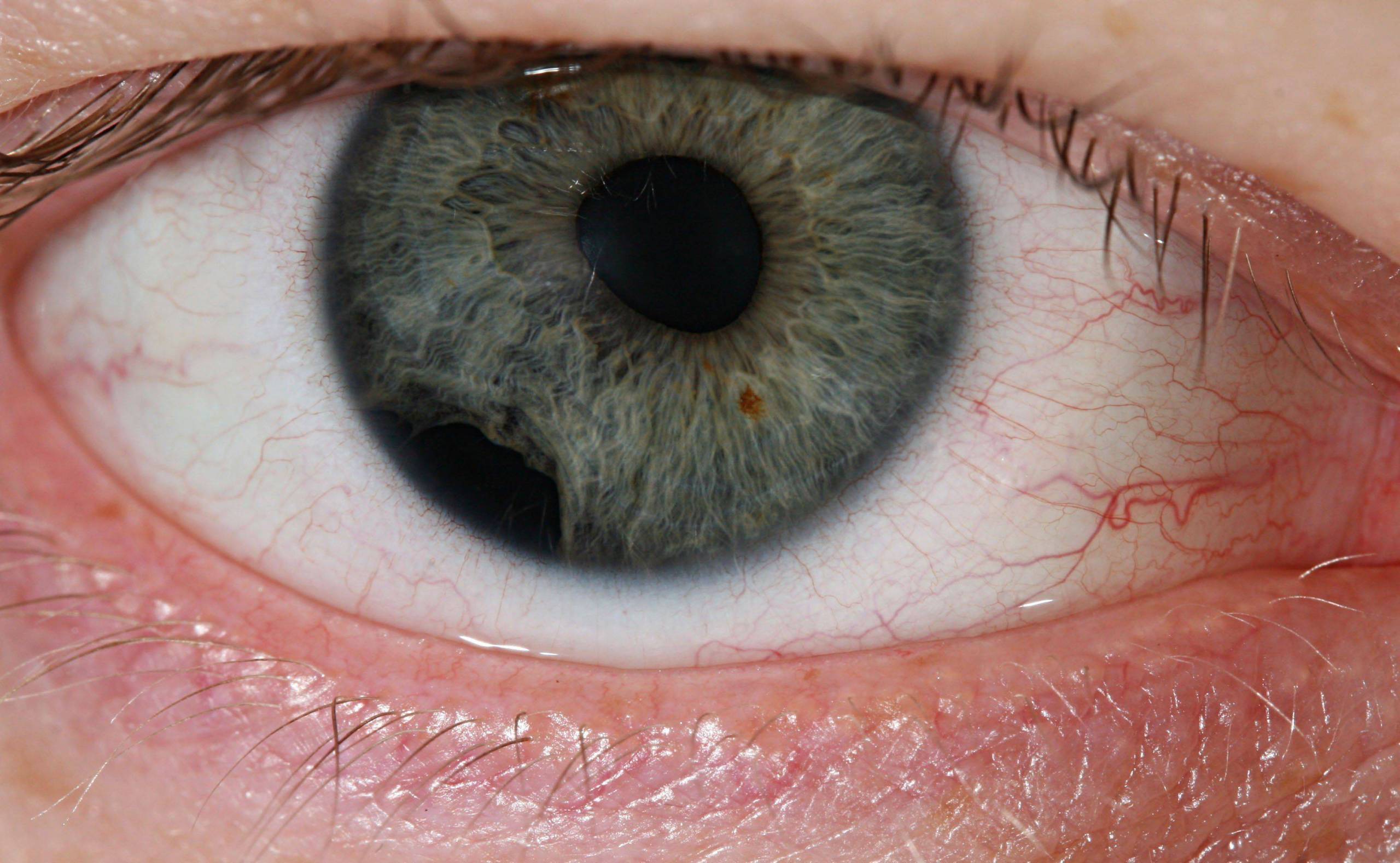 Как выглядит травма на глазу Глазная травма