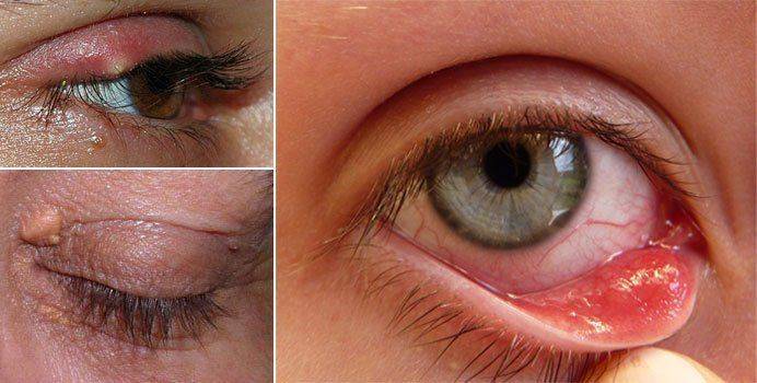 Возможный вид уплотнения на веке Как может выглядеть уплотнение на веке